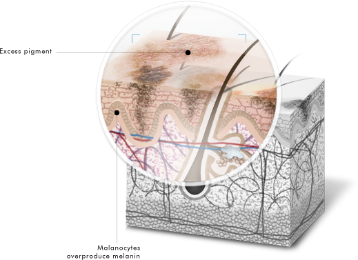 Skin Discoloration