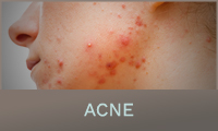 Acne