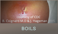 Boils
