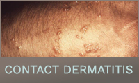 Contact Dermatitis