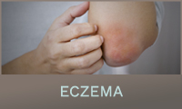 Eczema