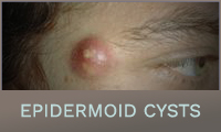 Epidermoid Cysts
