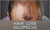 Hair Loss (Alopecia) Hair Loss (Alopecia)