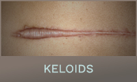 Keloids