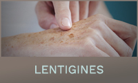 Lentigines