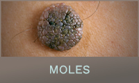 Moles Moles
