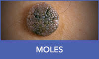 Moles Moles