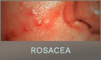 Rosacea