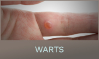 Warts