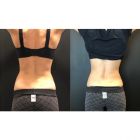 CoolSculpting® Elite