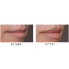 JUVÉDERM VOLBELLA® XC