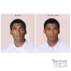 Botox Before And After Results For Men