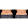 CoolSculpting before and after