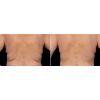 CoolSculpting before and after