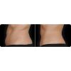 CoolSculpting before and after