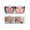 Fotofacial RF® B&A