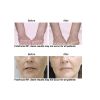 Fotofacial RF® B&A2