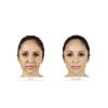 JUVÉDERM® Ultra Plus (No Options)