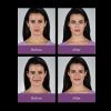 JUVÉDERM VOLLURE™ XC  Before and After