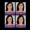 JUVÉDERM VOLLURE™ XC  Before and After