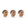 Juvederm Voluma XC B&A