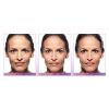 JUVÉDERM® Ultra (no options)
