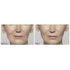 Restylane® Lyft before and after