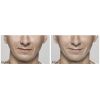 Restylane® Lyft before and after