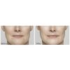 Restylane® Lyft before and after
