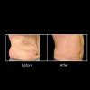 CoolSculpting before and after