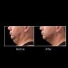 CoolSculpting before and after