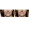 Restylane before and after