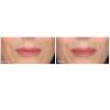 Restylane before and after