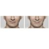 Restylane before and after