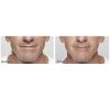Restylane before and after