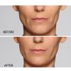 Restylane® Defyne Before and After