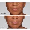 Restylane® Defyne Before and After