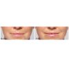 Restylane® Silk before and after