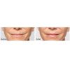 Restylane® Silk before and after
