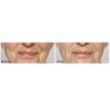 Restylane® Silk before and after