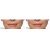 Restylane® Silk before and after