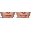 Restylane® Silk before and after