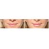 Restylane® Silk before and after