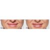 Restylane® Silk before and after