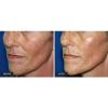 Sublime™ Skin Contouring Before and After