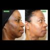 VI Peel Precision Plus B&A