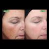 VI Peel Precision Plus B&A