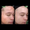 VI Peel Purify B&A