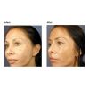 VI Peel PURIFY with Precision Plus