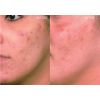VI Peel PURIFY with Precision Plus